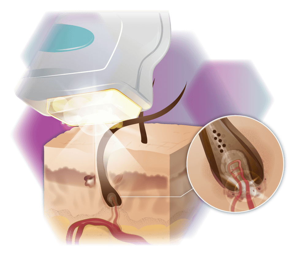 graphic super hair removal mode of action
