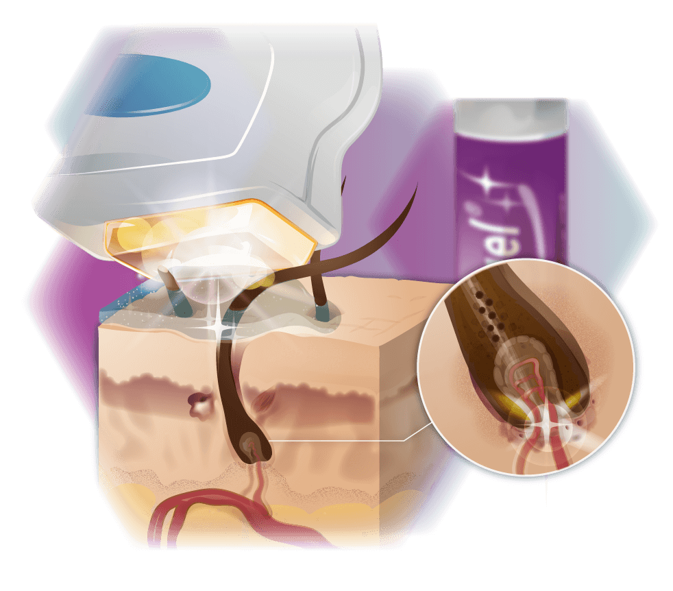 Infographic mode of action XENOgel® Technology