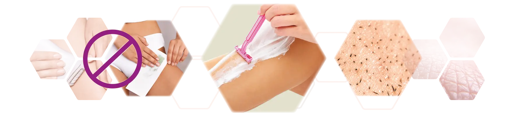 photo set treatment preparation SHR