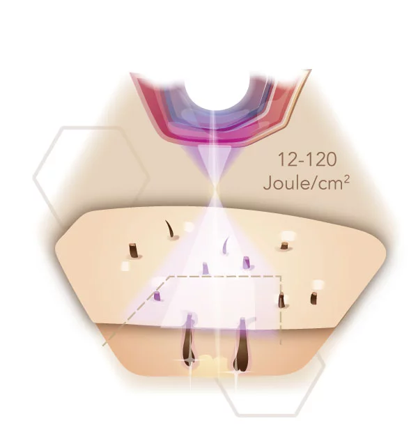 Infografik Energielevel bei IPL