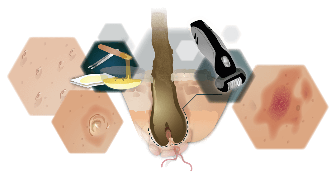illustration common hair removal methods